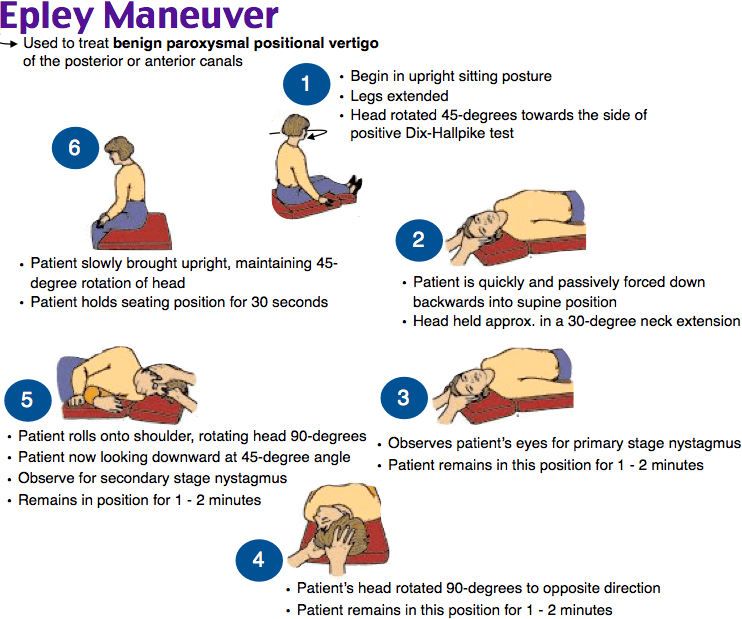 Epley maneuver illustration