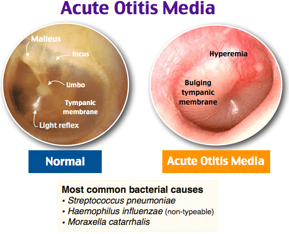 Acute Otitis Media