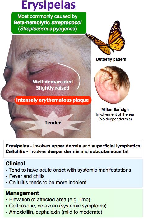 Mastoiditis