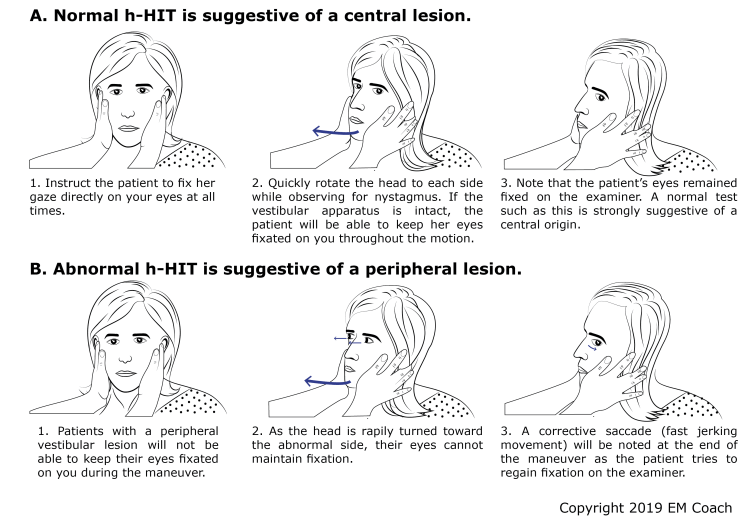 Head impulse test illustration