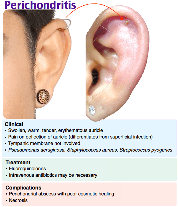 Perichondritis