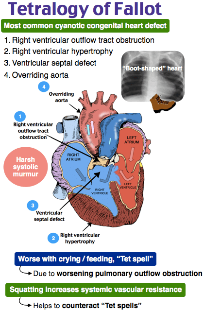 Tetralogy of Fallot anatomy