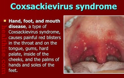 coxsackievirus-B-Chronic-sore-throat-symptoms.jpg