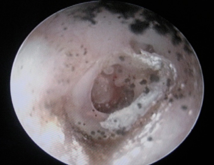 Otomycosis