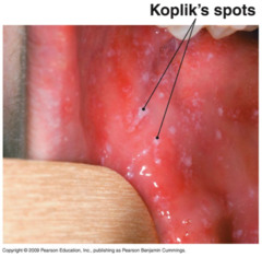 koplik_spots2.jpg