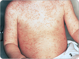 Measles_torso_MEDIMG_PHO_EN.jpg