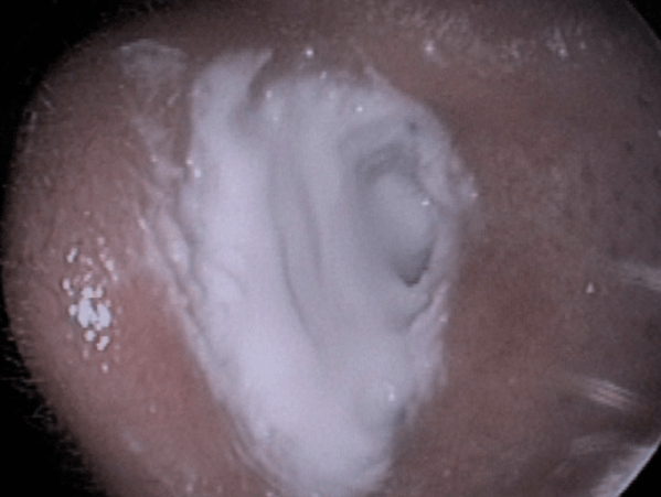 Clotrimazole cream application
