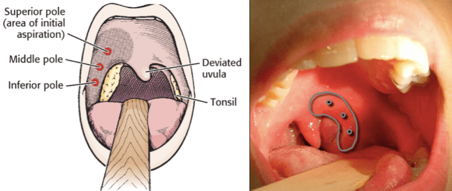 PTA aspiration needle placement