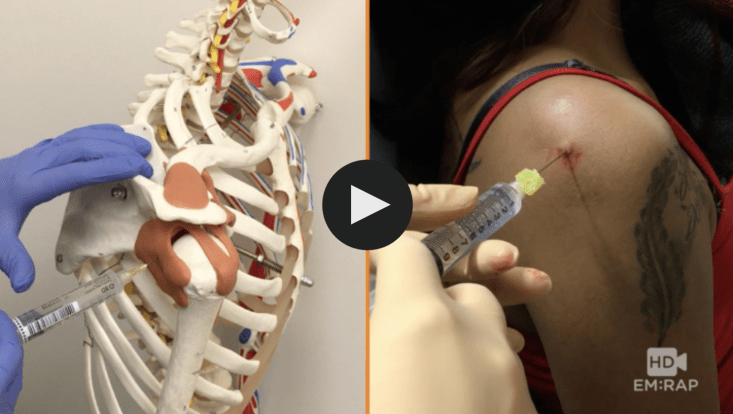 Shoulder injection landmarks