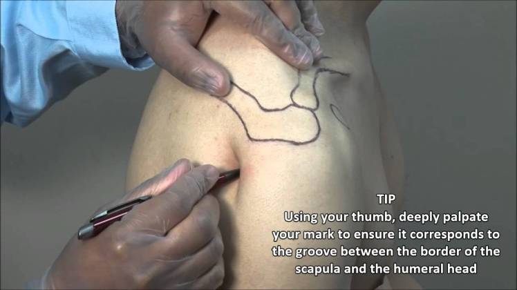 Shoulder injection approach
