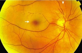 Central-Retinal-Artery-Occlusion.jpg