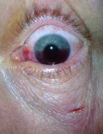 Hyphema