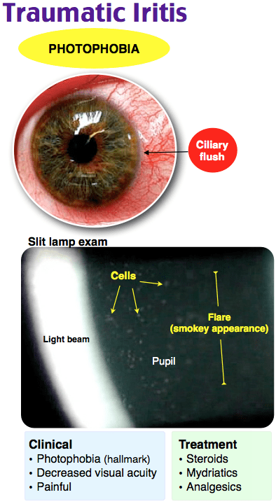 Traumatic iritis