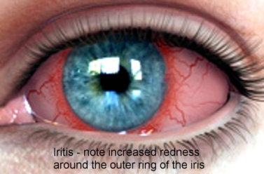 iritis_anterior_uveitis-resized-600.png