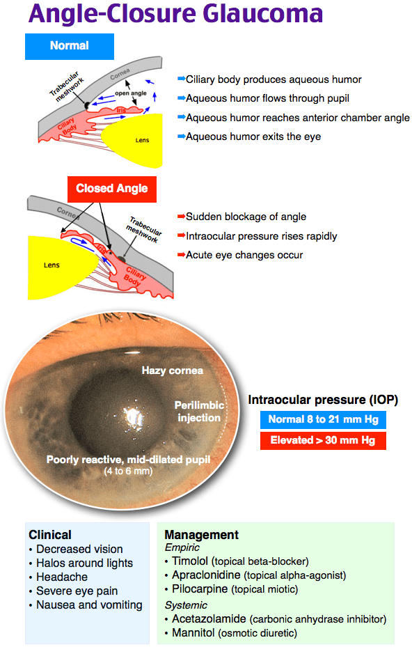 Acute angle-closure glaucoma