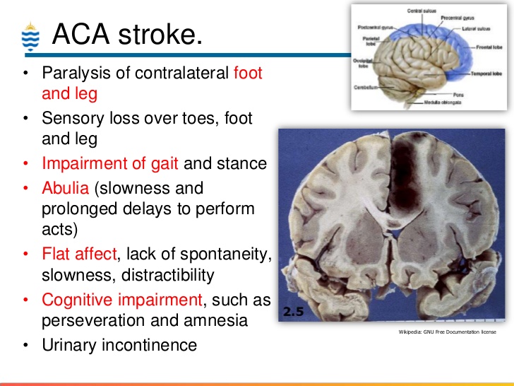 ACA stroke territory diagram