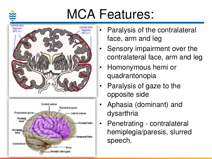 MCA stroke territory diagram