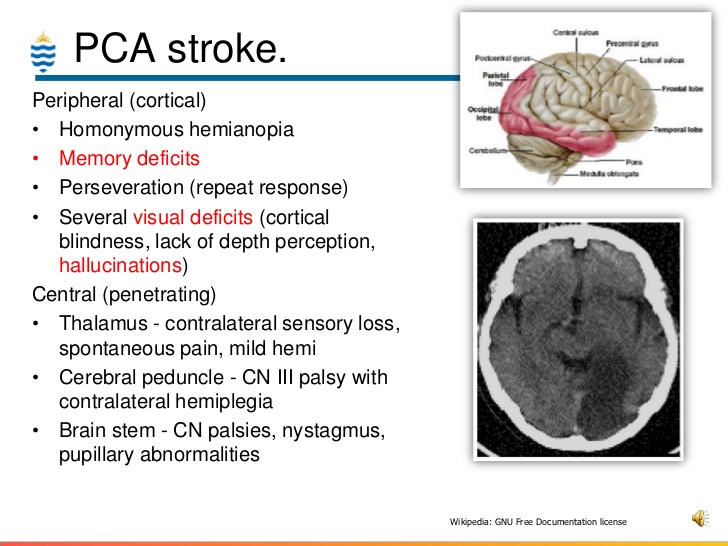 PCA stroke territory diagram