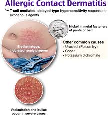 Contact dermatitis