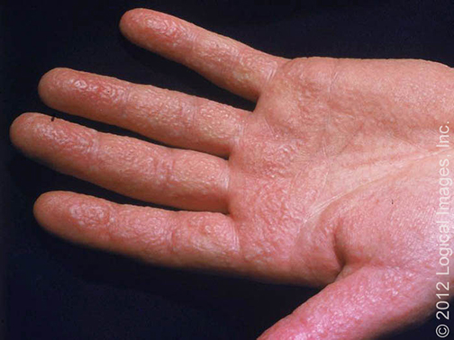 Severe dyshidrotic eczema