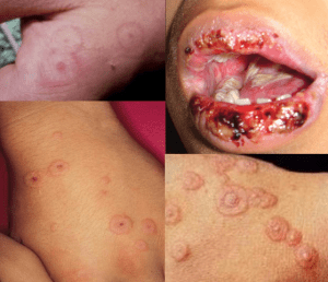 Erythema multiforme targetoid lesions