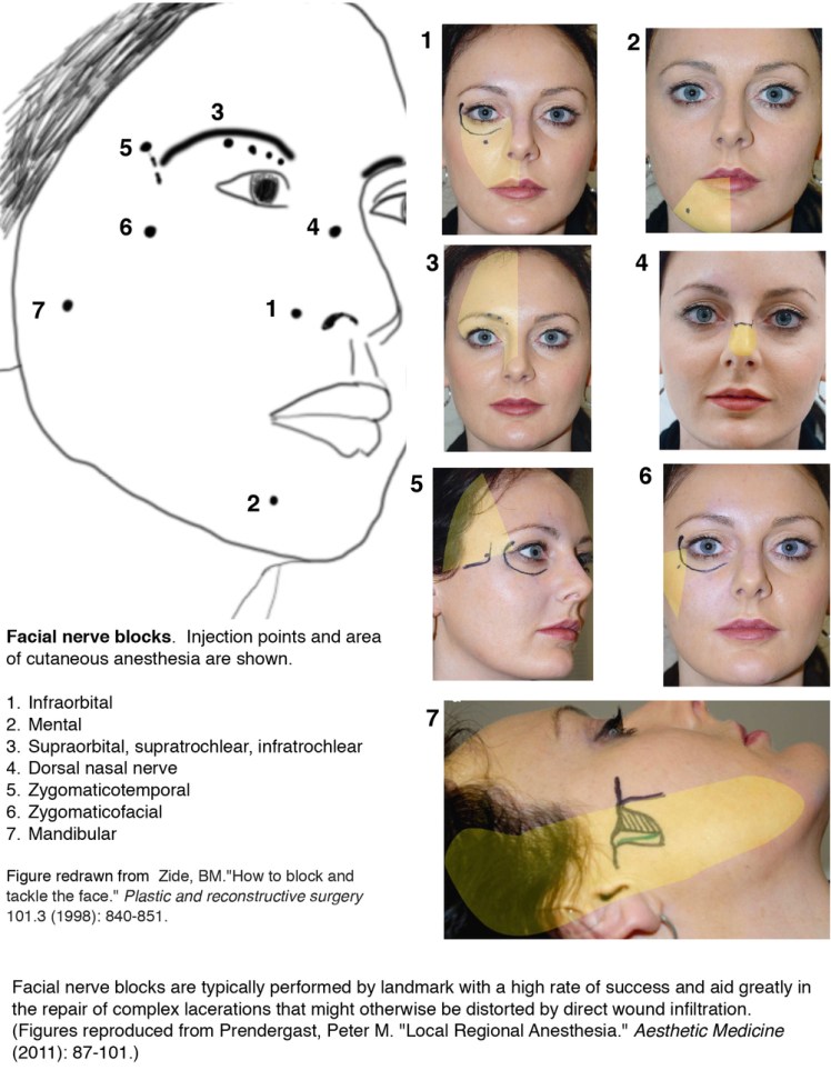 Facial nerve block landmarks