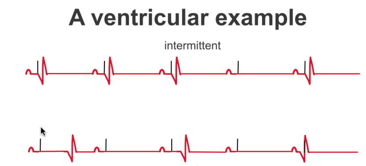 ECG showing failure to capture - pacing spikes present without following QRS complexes