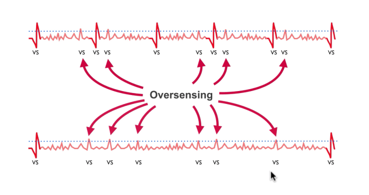 ECG showing failure to pace with oversensing - pacing spikes absent despite device programming