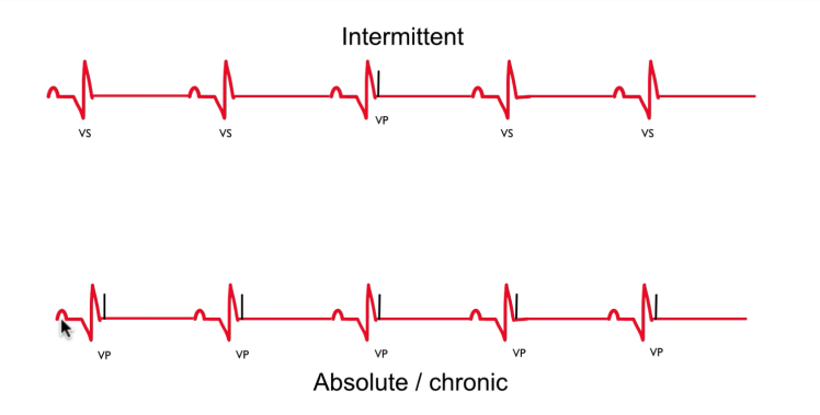 ECG showing failure to sense - pacing spikes appear during native QRS and T-waves (competitive pacing)