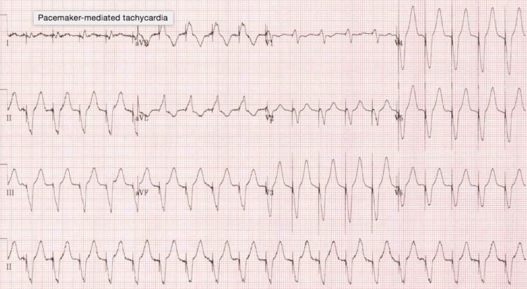 ECG showing pacemaker-mediated tachycardia - regular tachycardia with 1:1 atrioventricular relationship