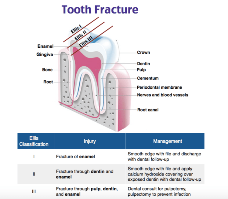 Ellis tooth fracture classification