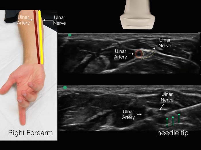 Ultrasound ulnar nerve
