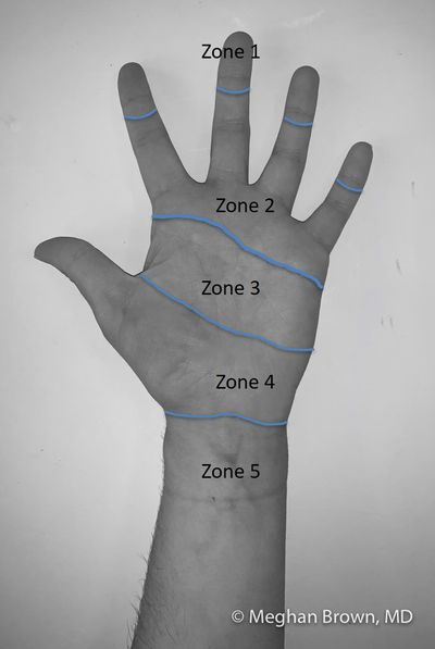 Flexor tendon zones