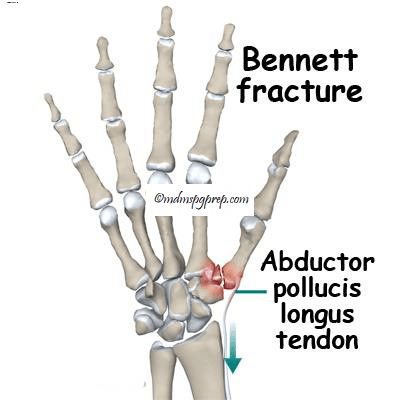 Bennett fracture