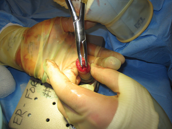 Finger amputation zones