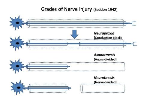 Nerve injury types