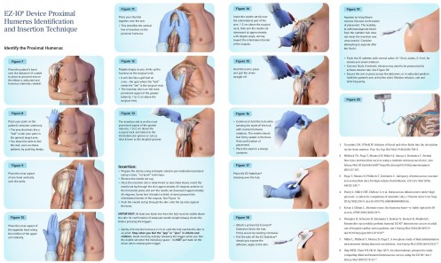 humerus-procedure-instructions-ioaccess-placement-original.jpg