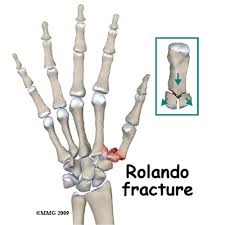 Rolando fracture