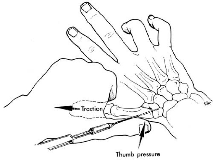 Thumb fracture reduction technique