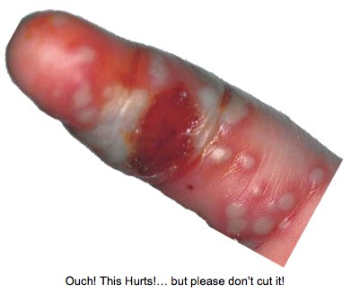 Herpetic whitlow vesicles