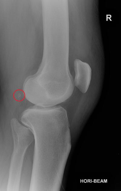 Fabella — normal accessory ossicle