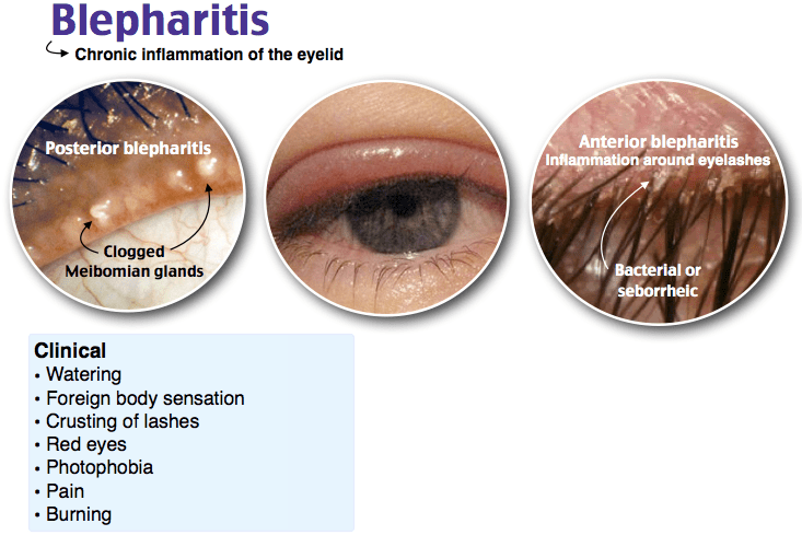 Blepharitis