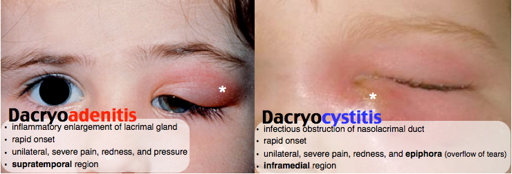 Dacryoadenitis and Dacryocystitis