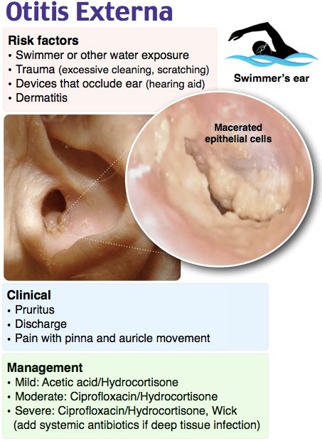 Otitis Externa