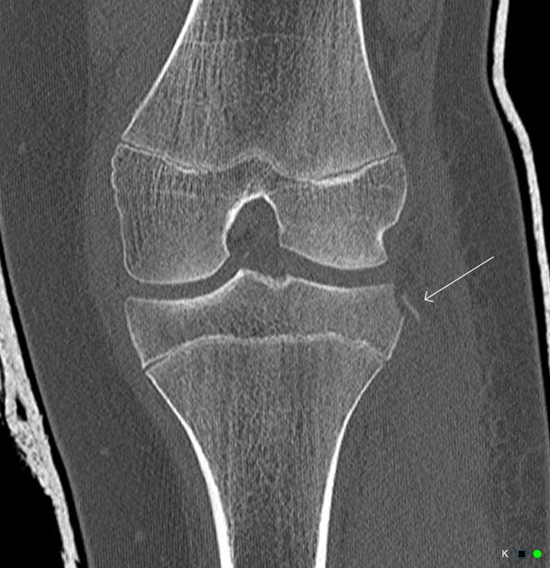 Segond Fracture