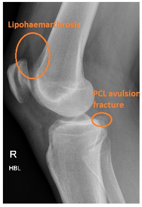 PCL Avulsion Fracture