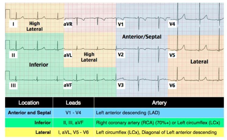 Posterior MI full ECG example