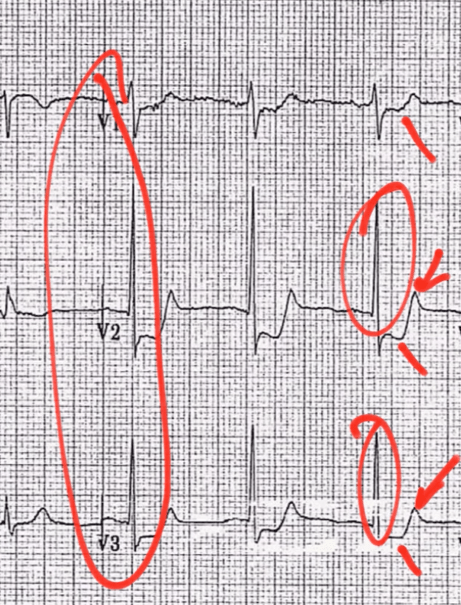 Posterior MI ECG pattern showing ST depression and tall R waves in V1-V3