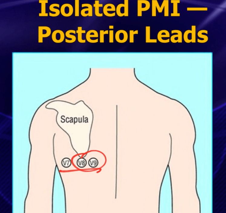 Posterior lead placement and resulting ST elevation