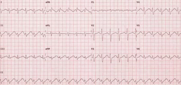 TCA toxicity ECG findings